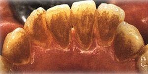 Что такое зубной камень?